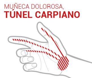 síndrome túnel carpiano